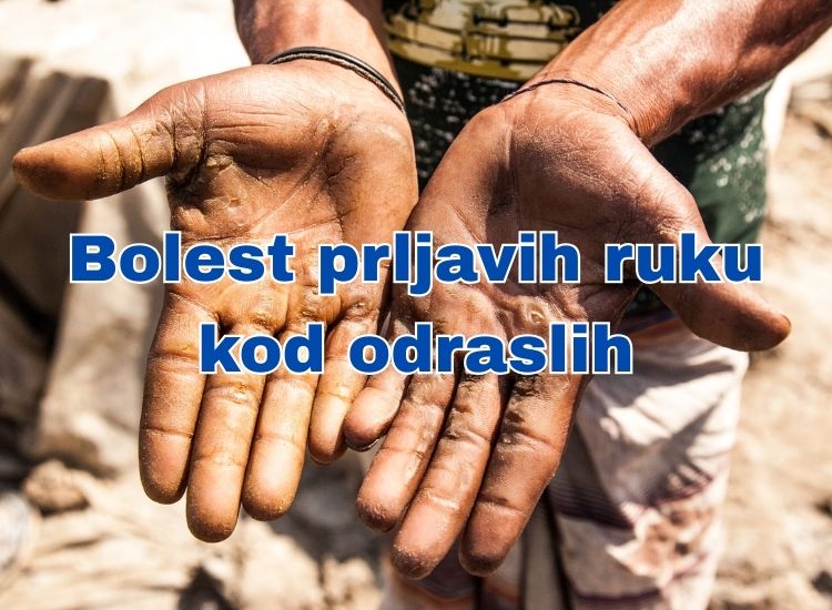 bolest prljavih ruku kod odraslih