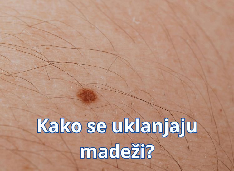 kako ukloniti madež na prirodan način kako ukloniti madež na licu