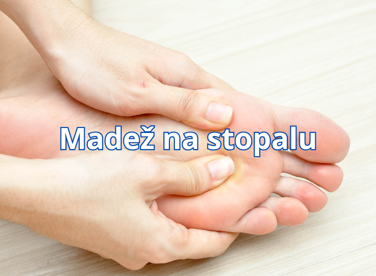 madež na stopalu madež na tabanu 